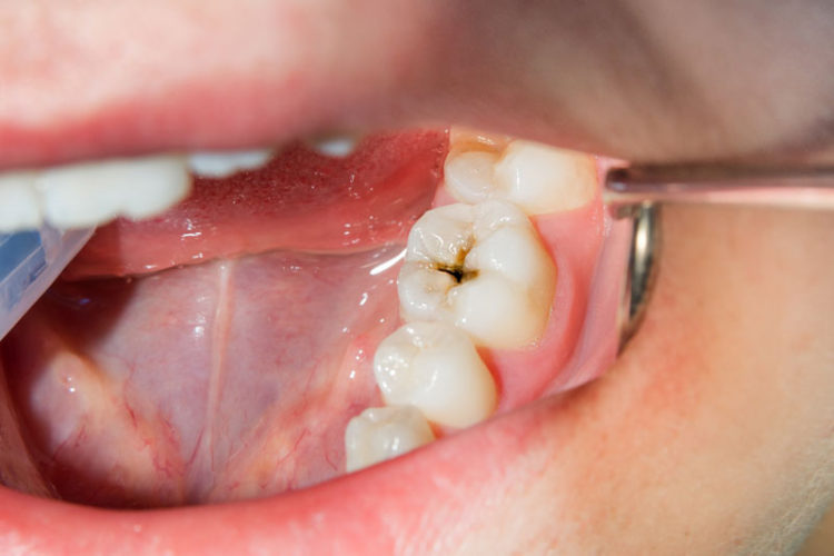 Main pathologies of the Mouth